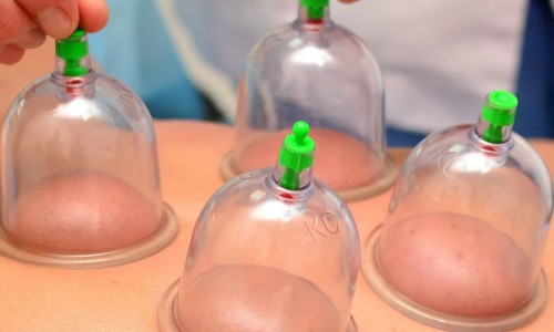 Cupping Promotes